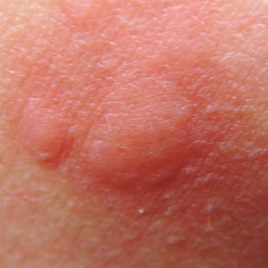 test per allergia al nichel - ponfo